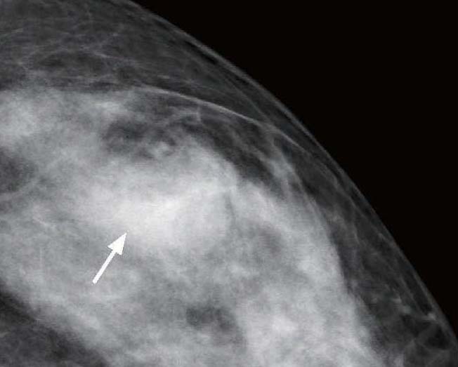 第六節(jié) 乳腺囊性增生癥